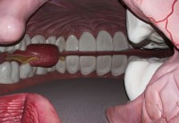 Corpus - v ústní dutině